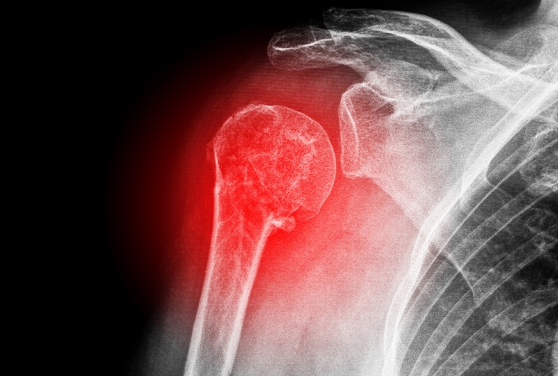 imageuploads/covered/2025/07/17/shoulder-dislocation-pain-warning-signs.jpg