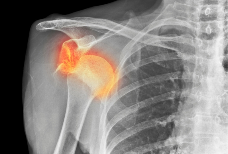 shoulder-dislocation-pain-warning-signs