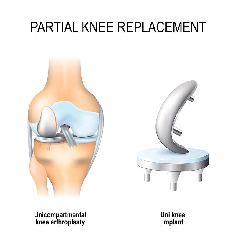 partial knee replacement benefits