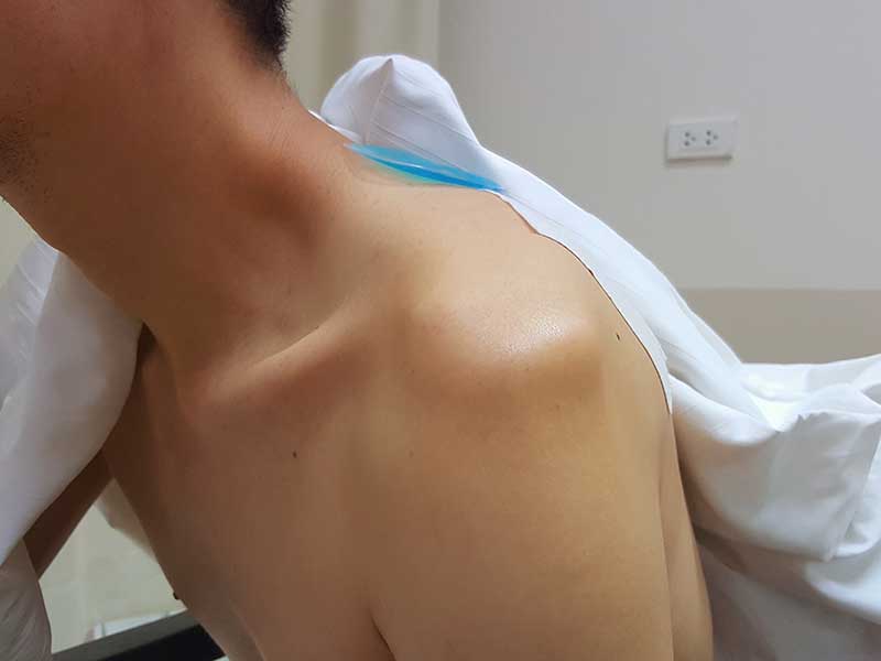 Total shoulder replacement in chennai, tamil nadu