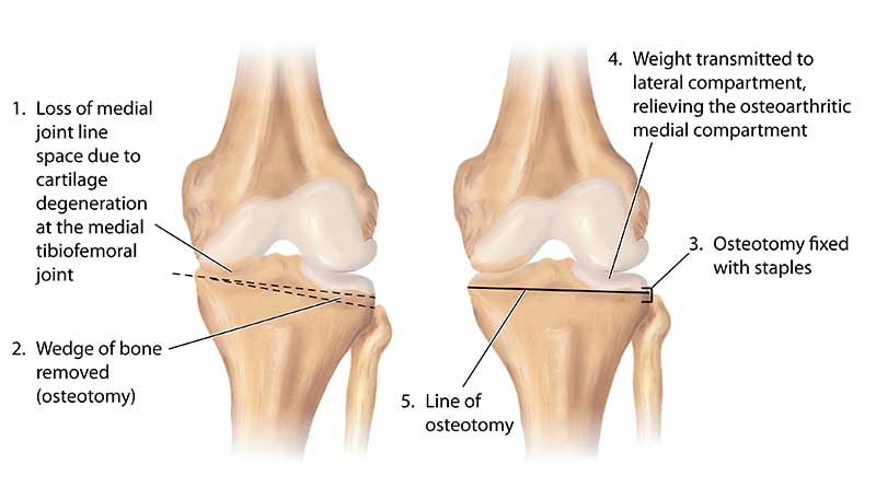 knee osteotomy in chennai, tamil nadu