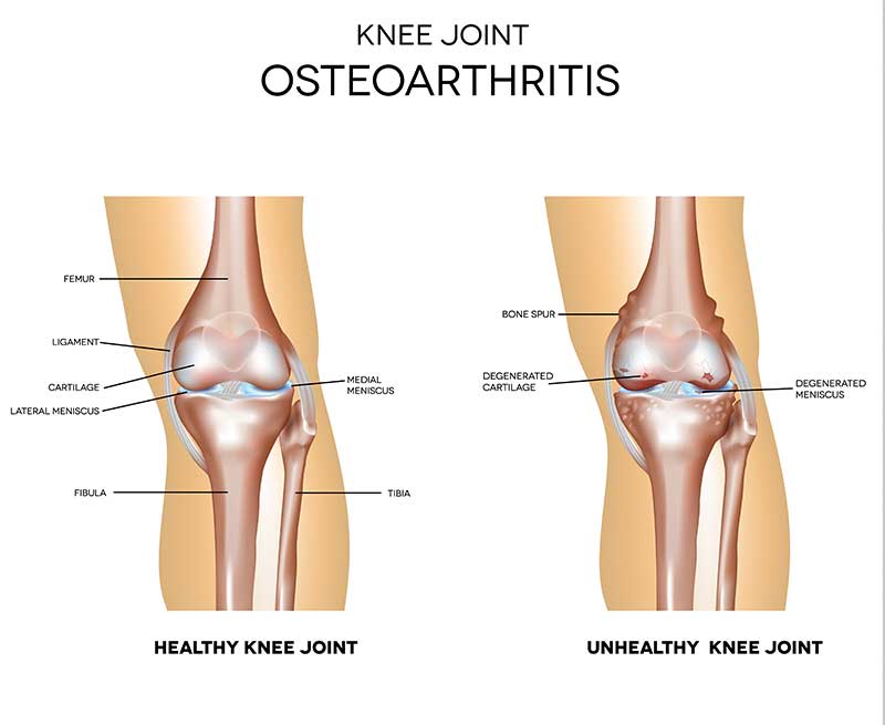 osteoarthritis knee treatment