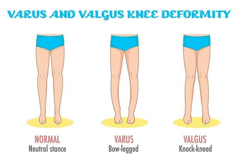 varus and valgus deformity treatment chennai