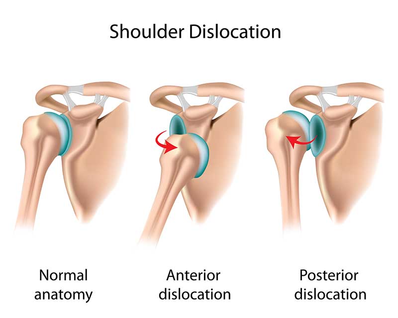 dislocated shoulder treatment in chennai, tamil nadu