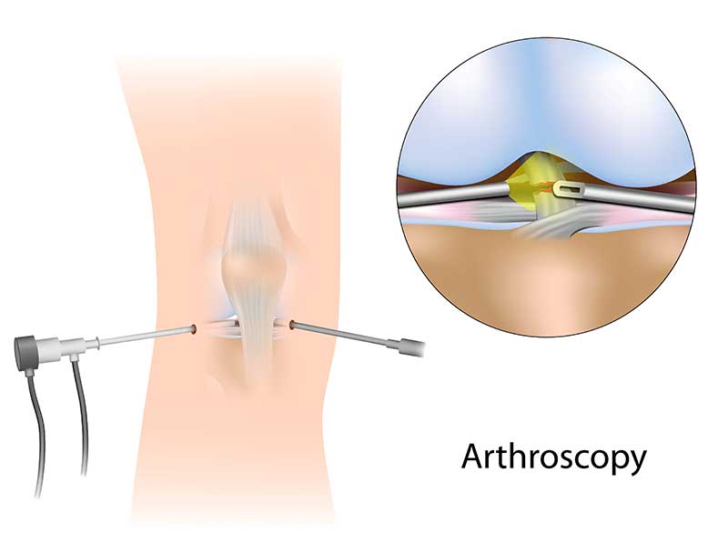 acl, pcl knee surgery in chennai, tamil nadu