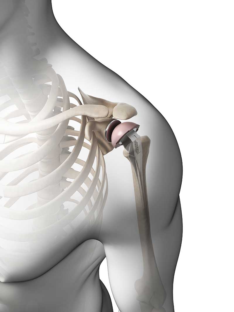 Best Arthroscopic Shoulder surgeon in chennai