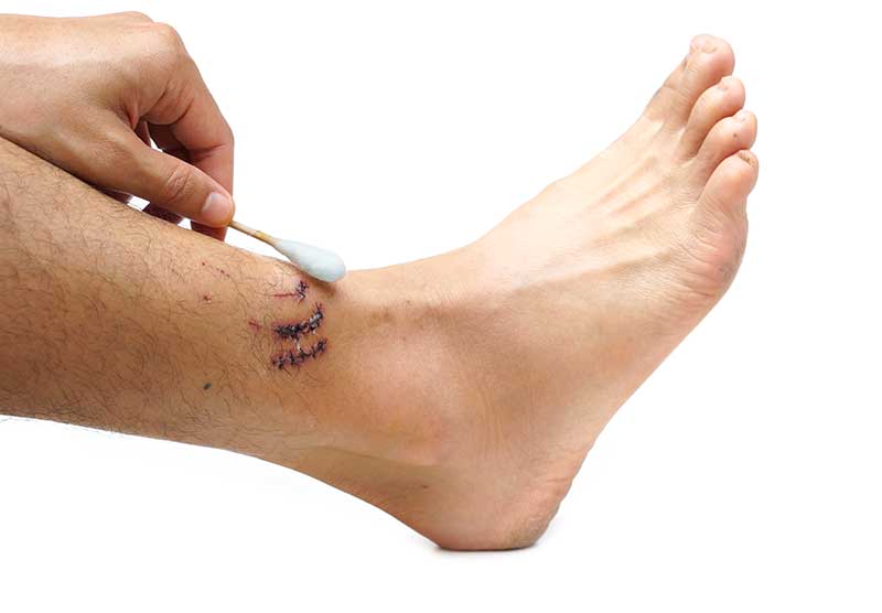 ankle fracture causes